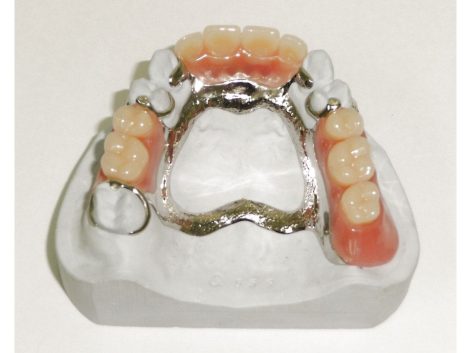 Partial dentures Jennifer Craig